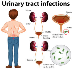 bladder cancer