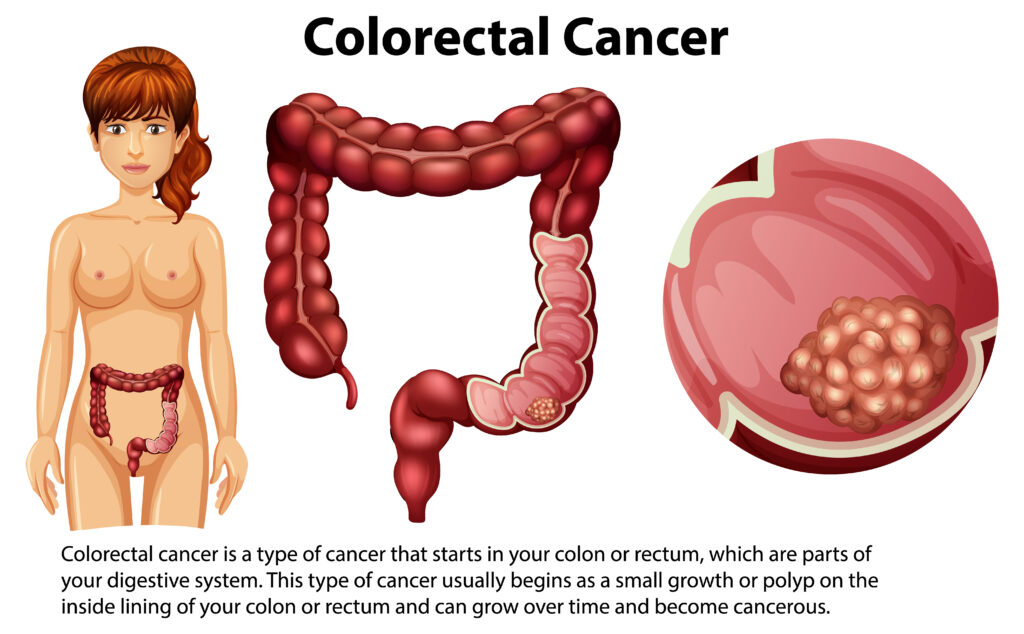 colorectal cancer