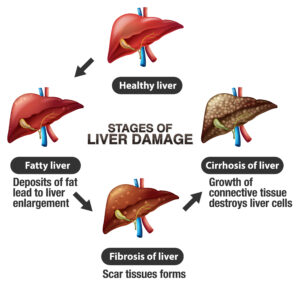 hepatitis